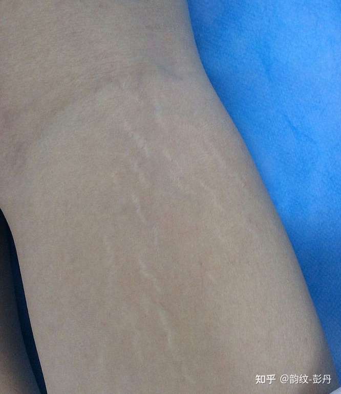 生长纹是皮肤被拉伸导致弹力纤维断裂形成的,不一定是长胖才会出现