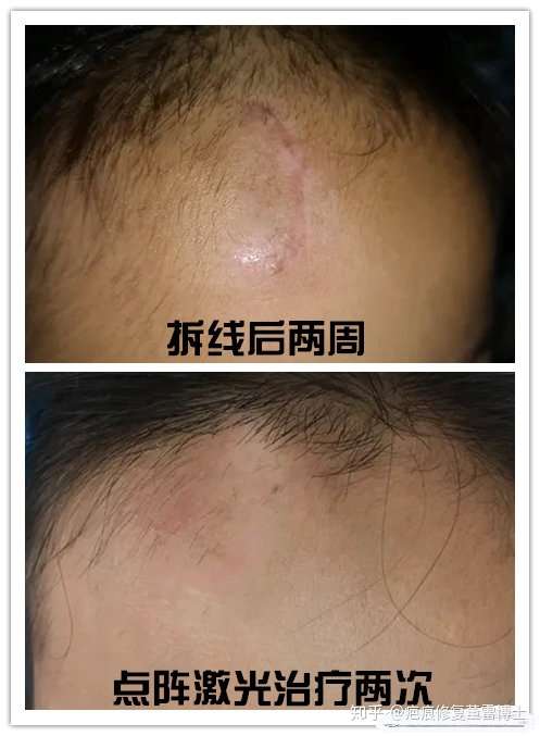 疤痕修复案例 - 知乎