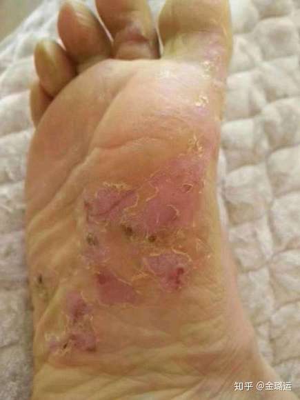 灰指甲是由皮肤癣菌感染引|起的甲病.