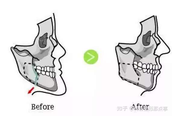 最主要还是单侧的咀嚼!而且由于下颌牙列