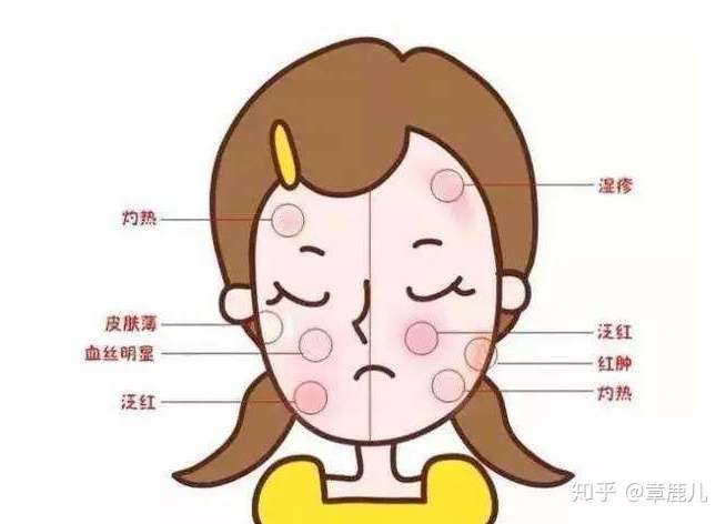 作为一个有红血丝的敏感肌的学生党,怎么选择面部护肤