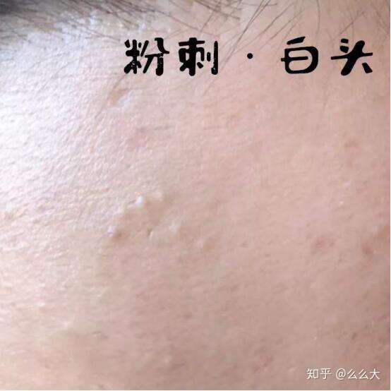 水杨酸好用吗?