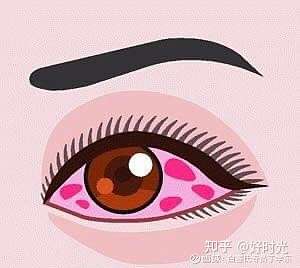 白塞病眼睛有什么症状