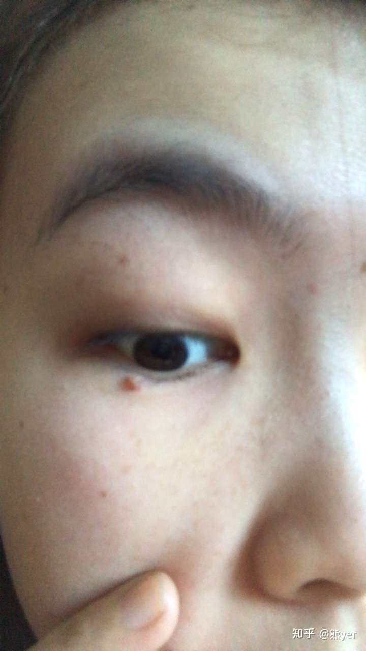 为什么眼睛周围会长小疙瘩?