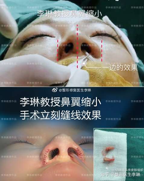 鼻翼缩小手术增生的几率很大吗?