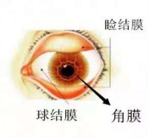 一字之差的结膜炎和角膜炎有什么不同