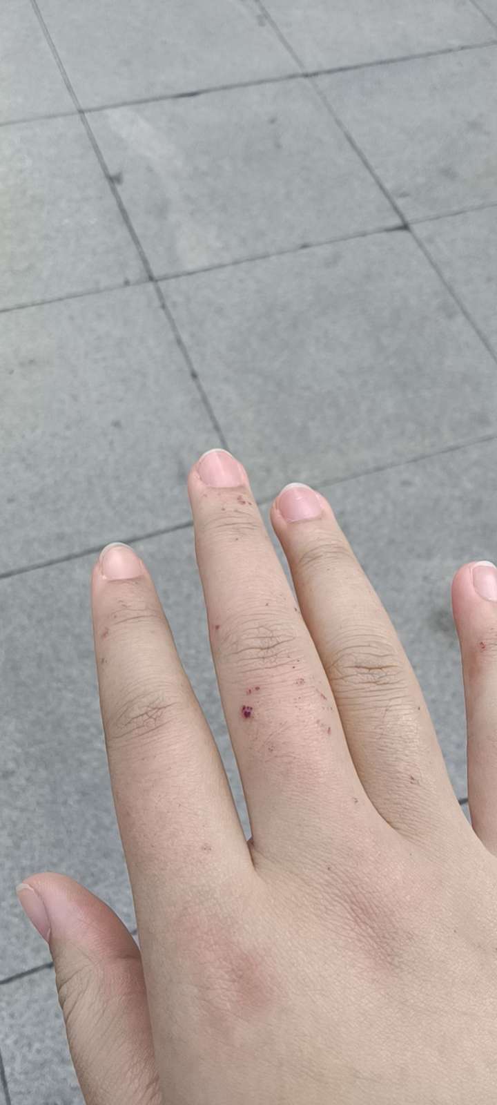 手上因为冻疮长的这些红疙瘩到底是什么东西?好多年都