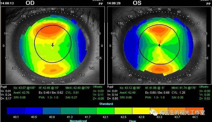 看图 圆锥角膜的角膜地形图呈现 我在北京潘家园眼镜城商圈,欢迎前来