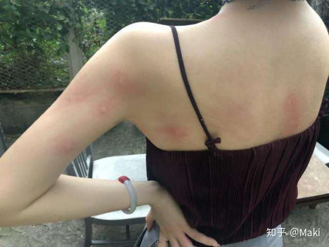被蚊子咬了怎么快速止痒?急?