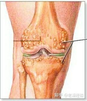 老人膝盖骨刺比较推荐什么护膝呢?