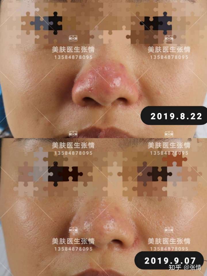 酒糟鼻中期用染料激光好些还是光子嫩肤.