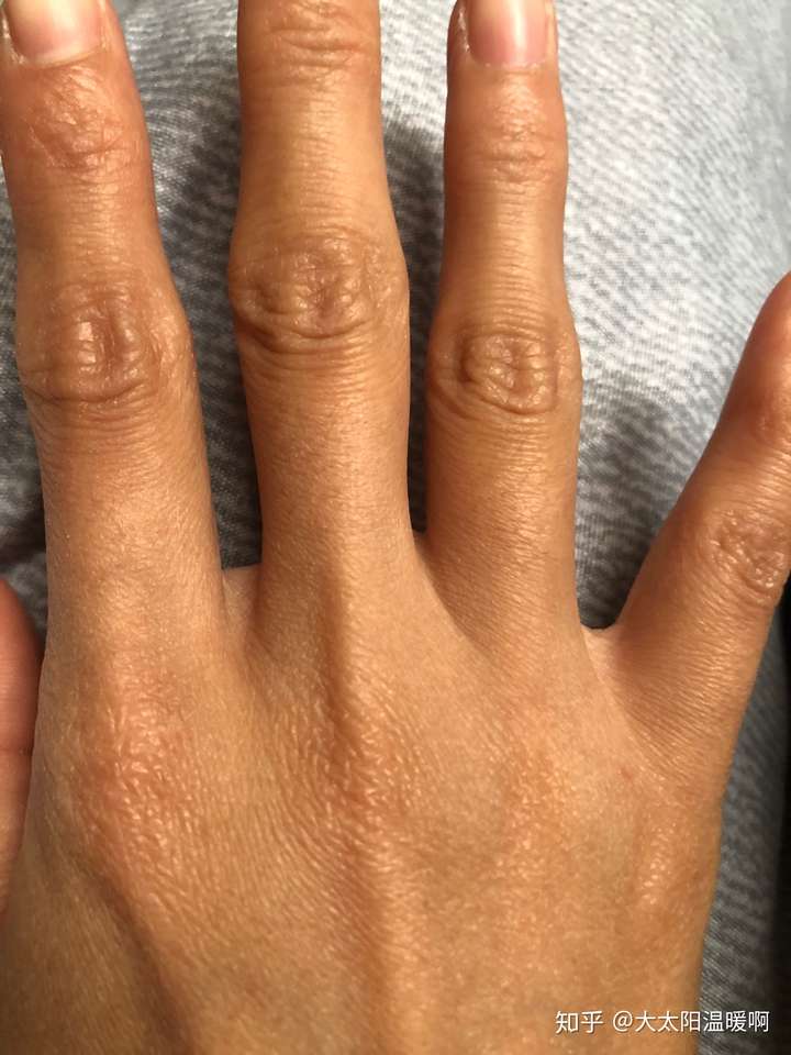 经常掰指节手指关节变粗且关节处皮肤变黑怎么处理?可以还原吗?
