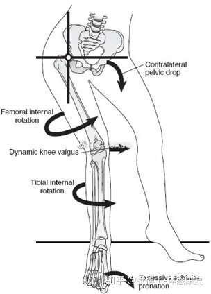 体态矫正膝超伸膝反弓的产生机制与矫正方法