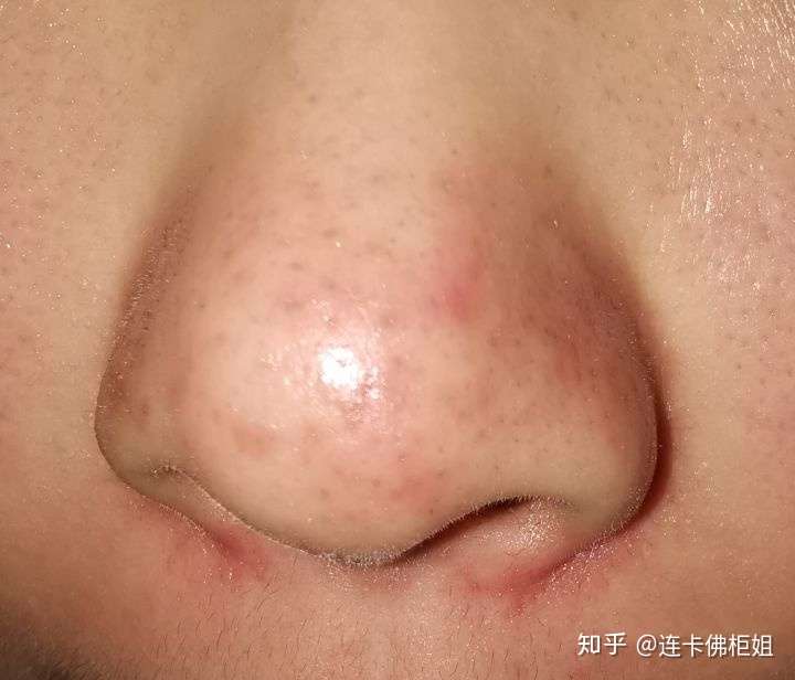 自己挤黑头后鼻子揭掉一层薄薄的皮,然后有个红印,有没有一样情况的
