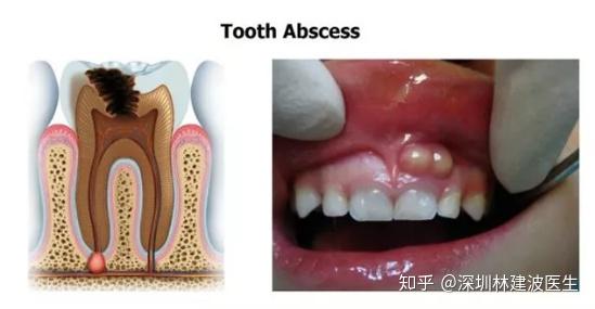 牙龈上长了一个脓包,这是什么情况?可以挑破吗?如何治疗牙龈脓包?