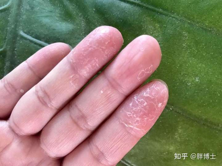 为什么我的脸到冬天就起皮爆皮?