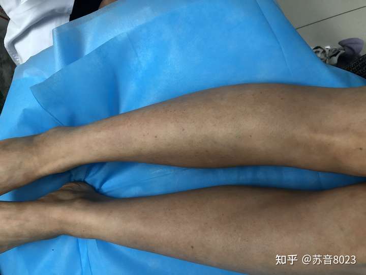 银屑病光疗费用和效果?如何?