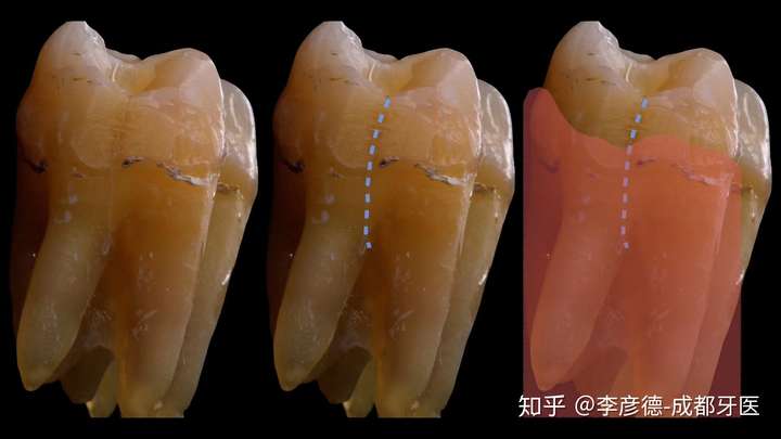 请问牙隐裂或者牙齿上有裂痕的朋友们,现在都怎么样了