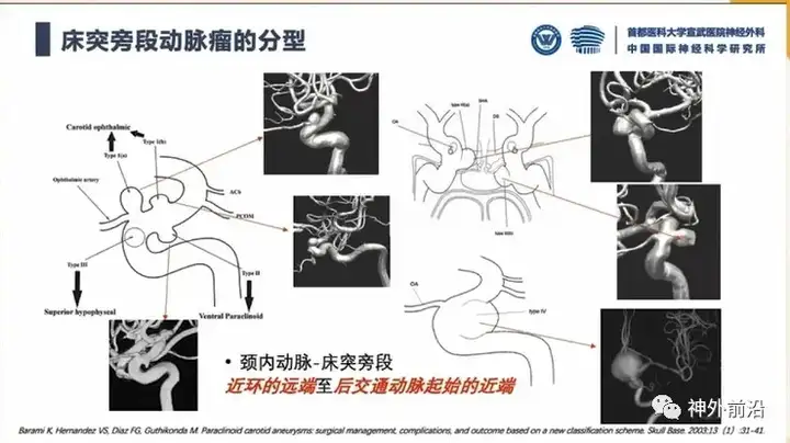 宣武医院张鸿祺床突旁段动脉瘤解剖与入路手术与血流导向治疗思考