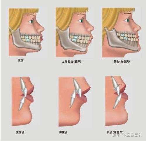 矫正牙齿对脸型的影响大吗 知乎