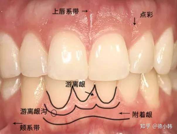 先说下健康牙龈长啥样 牙龈组织包括游离龈,附着龈和龈乳头三部分.
