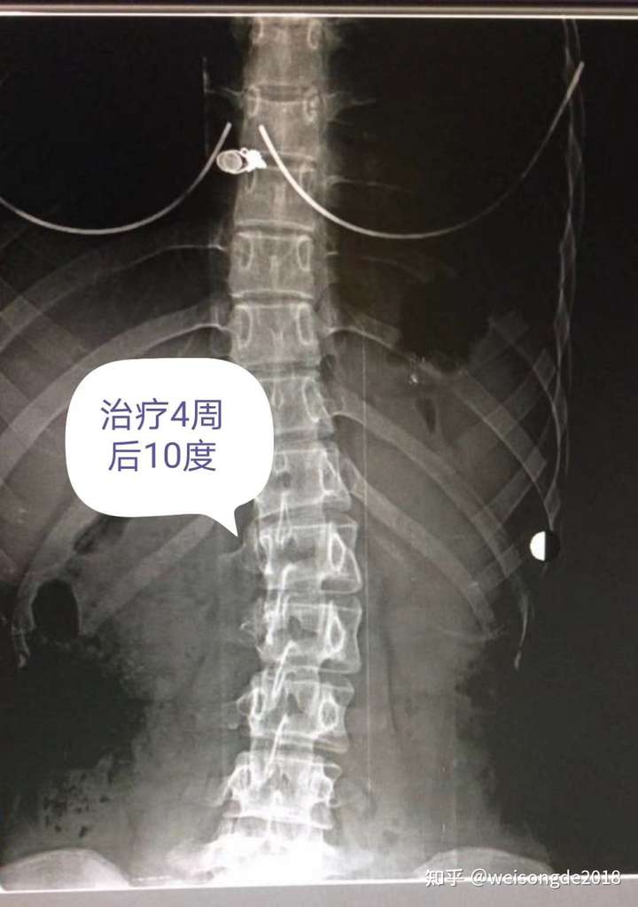 颈椎曲度变直究竟可不可以改善?