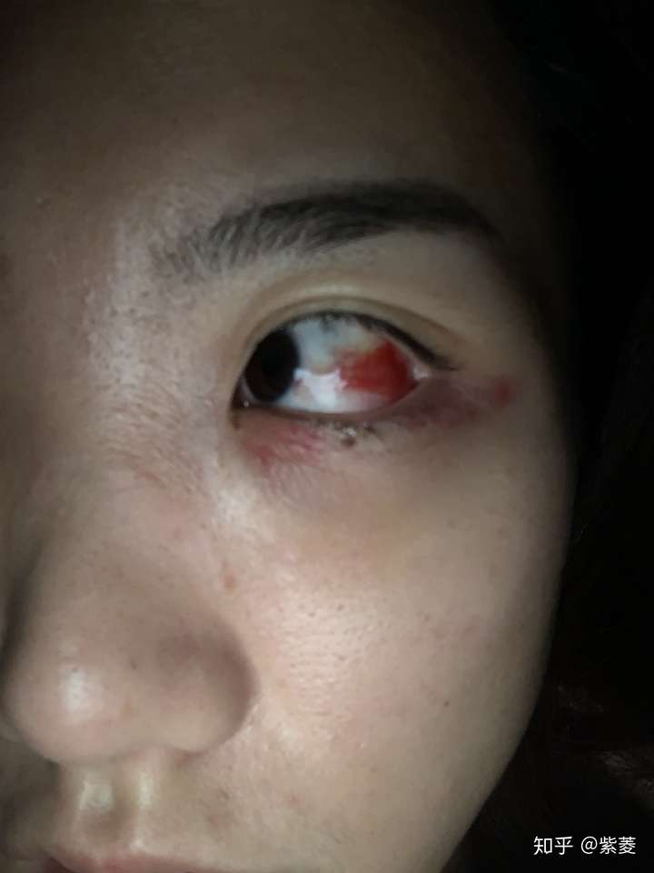 有做过祛眼袋手术的知友们可以分享一下经历和经验么?