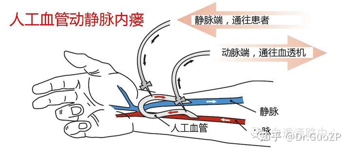 长期做透析的病人,有的会做一种手术,把单侧上肢的动静脉做一个吻合