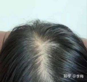 产后宝妈脱发掉发严重怎么办