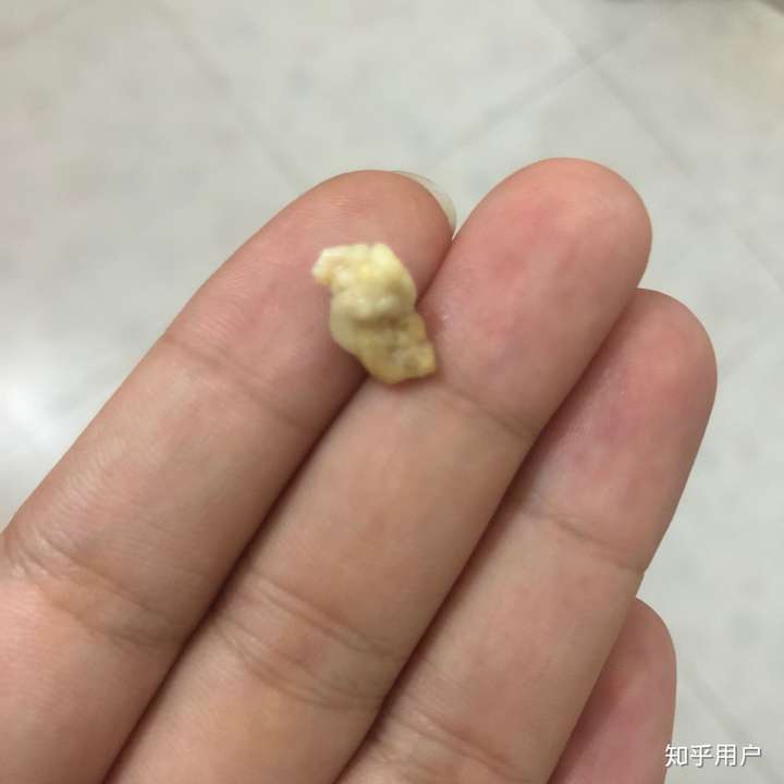 你见过最大的扁桃体结石有多大?