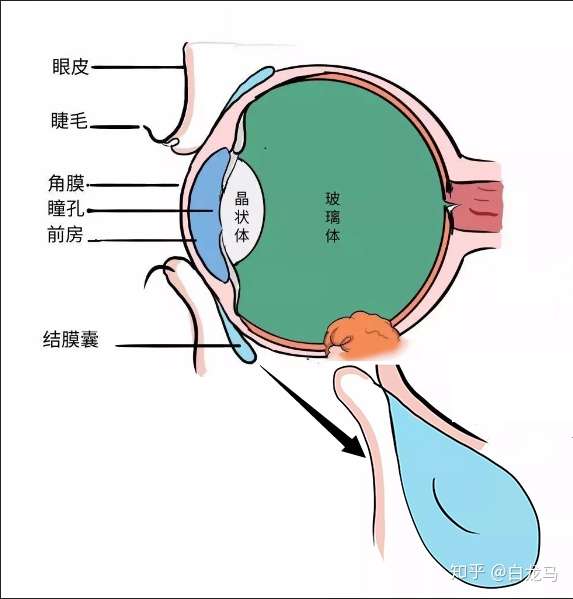 也不会跑到眼球后面,不见的眼睫毛其实早期都藏着了这个地方:结膜囊