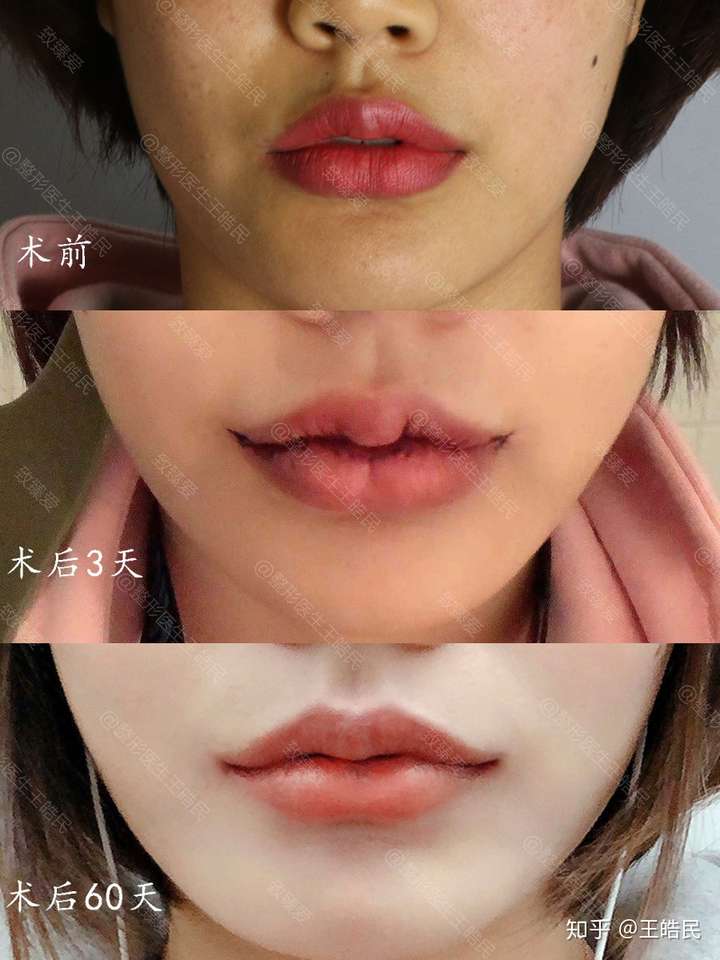 m唇手术,适合所有唇形模糊或较平,想要唇形更精致立体的情况,m唇手术