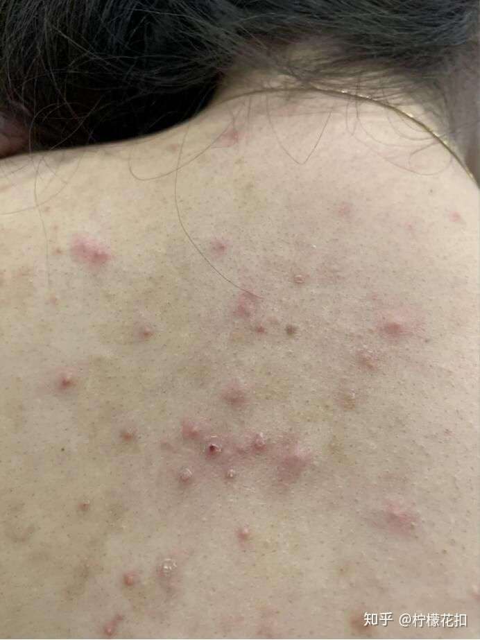 肩膀和后背长痘痘,改怎么解决?