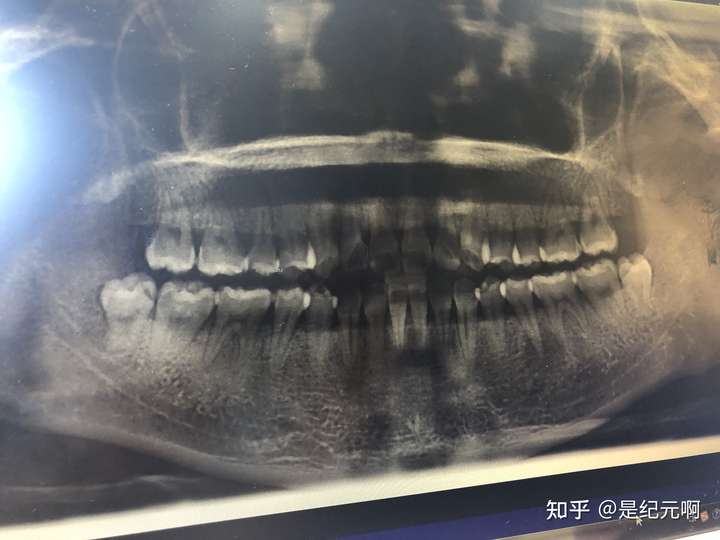 先贴个牙片