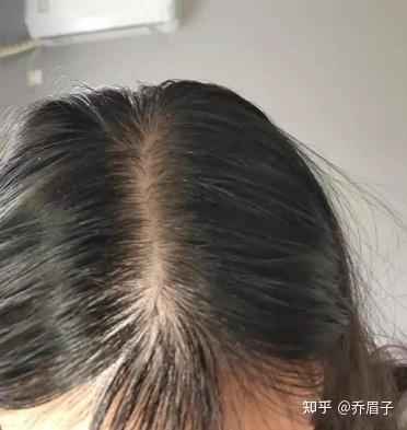 25岁女脱发严重,这样还有救吗?