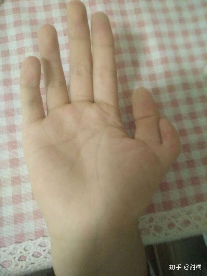 一只手有六个手指是种怎样的体验