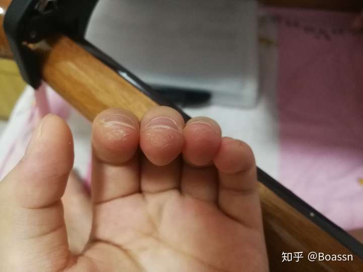 吉他按得指尖疼还要继续练吗