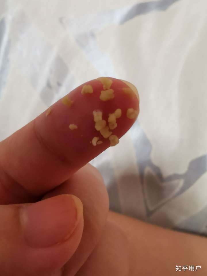 扁桃体结石是如何形成的?