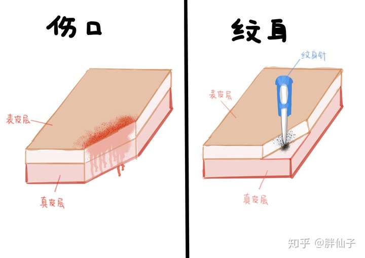 纹身伤口非常平整(排除技术不好的可能) 将色料颗粒刺进表皮层和真皮