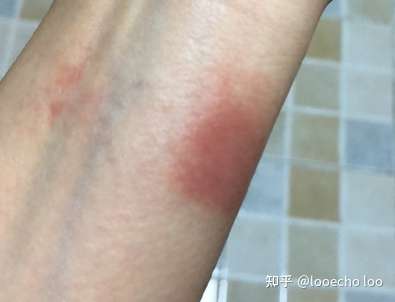 有没有果粉戴applewatch6海军蓝标配硅胶表带过敏的呢