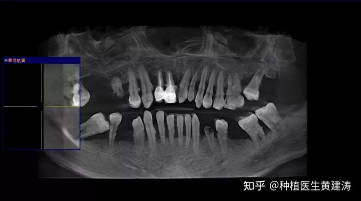 具体就是以下七颗牙: 02,牙槽骨量萎缩 缺牙后牙槽骨会随着吸收,并且