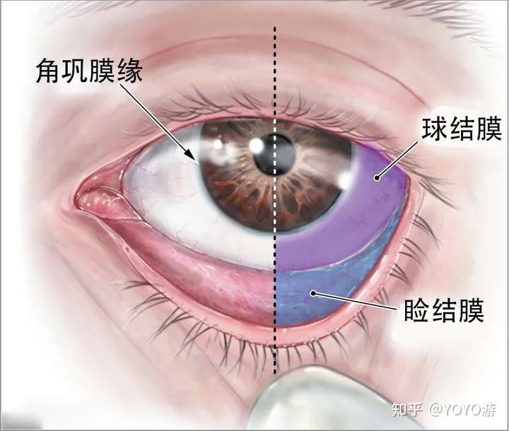 白眼球前的叫球结膜,上下眼皮表面的叫睑结膜.