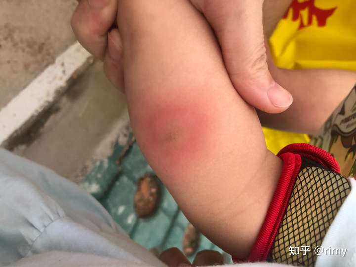 宝宝半岁以前,不怎么用手挠,虽说被蚊子咬了,但起码不会像上图那般.