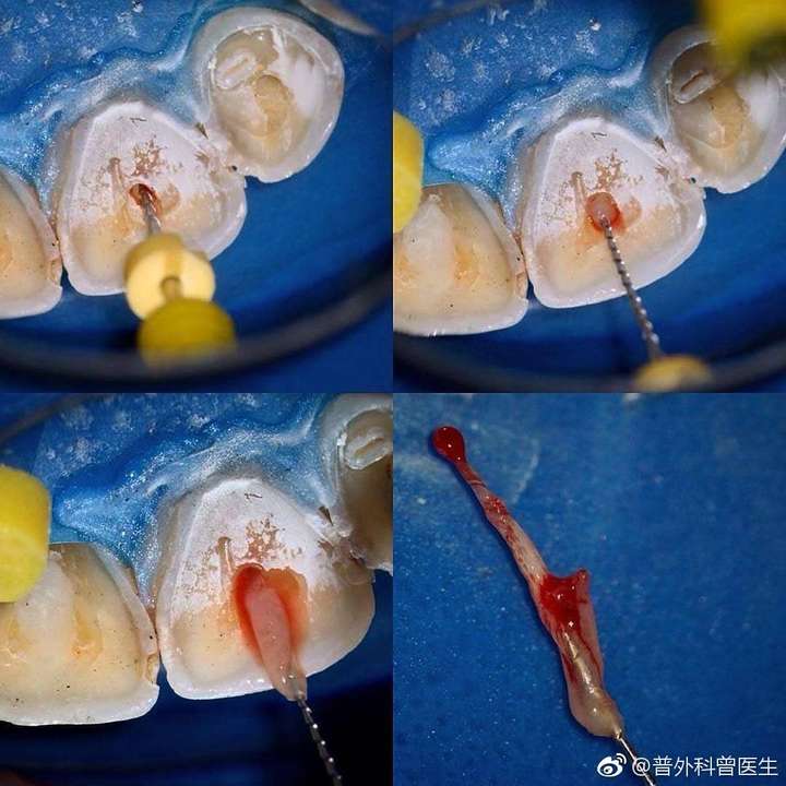 蛀牙不补可以吗?