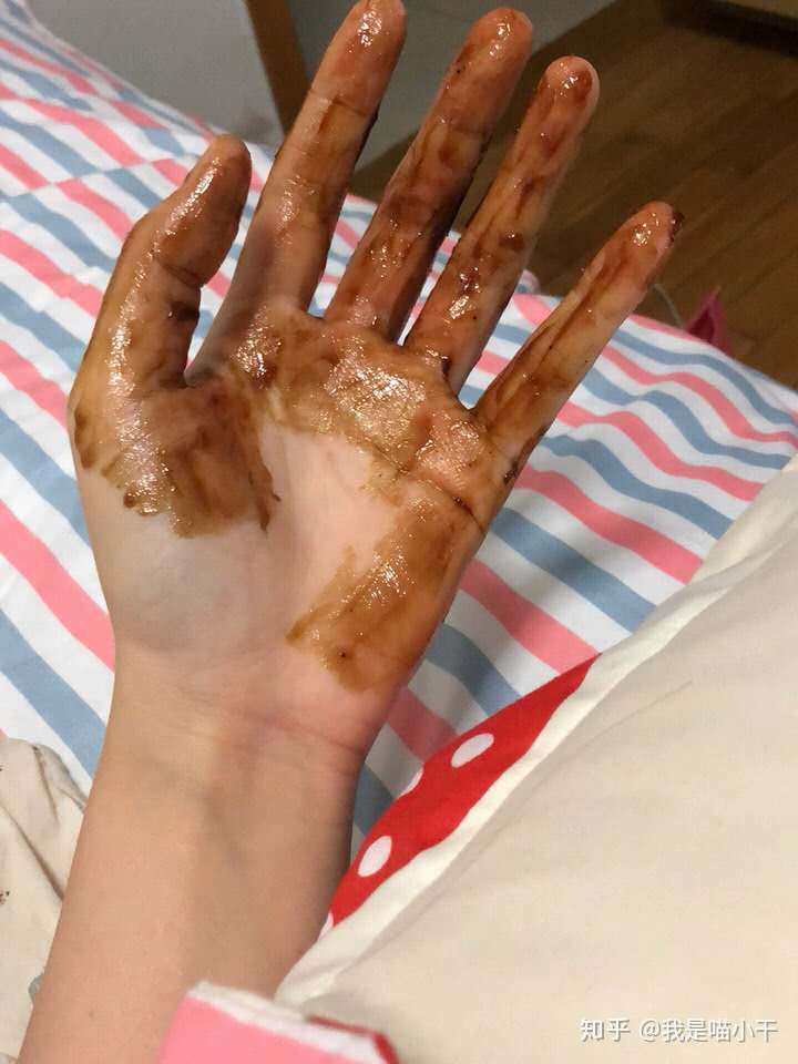 被油烫伤了怎么处理?