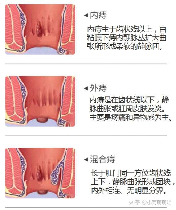 有哪些动作可以减小早期痔疮的体积