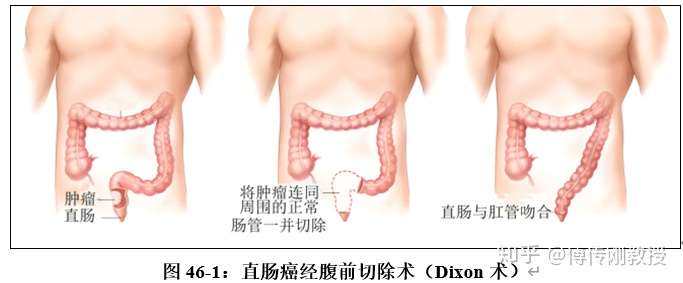 dixon手术是目前应用最多的一种保留肛门的术式,因为能够保留肛门