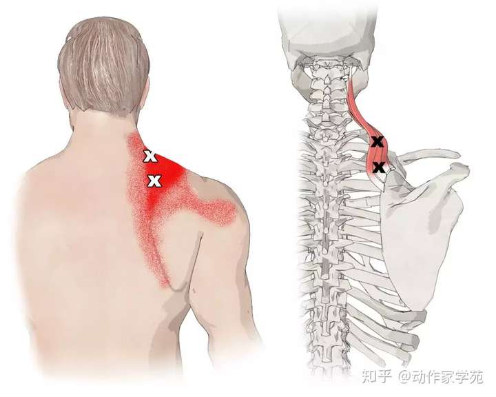 颈肩酸痛你的肩胛提肌放松了吗