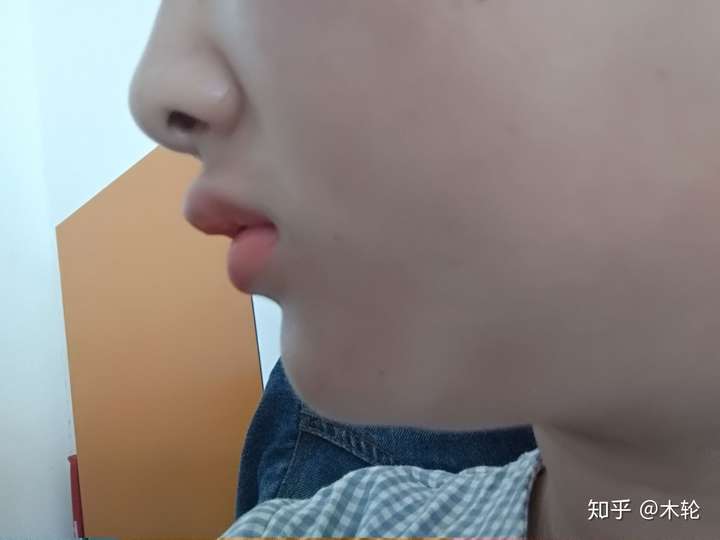 从小的口呼吸怎么办?