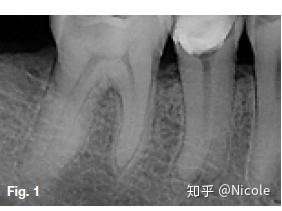 下颌第二前磨牙的形态变化